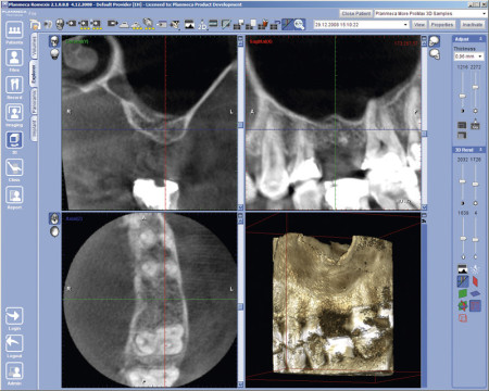 Das DVT zeigt eine knöcherne Zahnlücke in allen drei Dimensionen. In den beiden oberen Ansichten ist die Nasennebenhöhle als dunkler, luftgefüllter Hohlraum gut erkennbar.