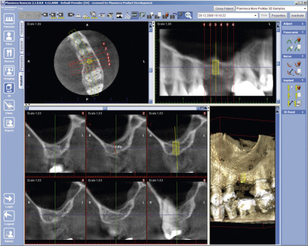Die Software kann nun Implantatpositionen (hier ein gelbes Implantat) simulieren. Der Vergleich zwischen notwendigen und tatsächlich vorhandenen Knochenvolumen wird so möglich.﻿